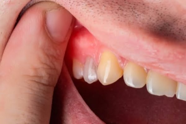 Gum disease treatment image