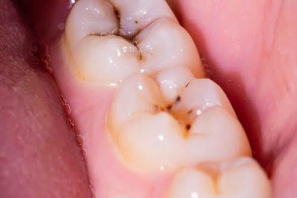 dental fillers image