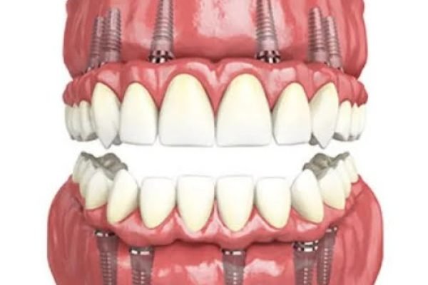 mouth rehablitation image