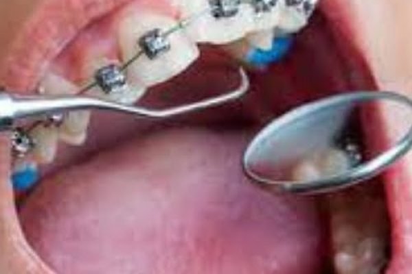 orthodontic treatment image