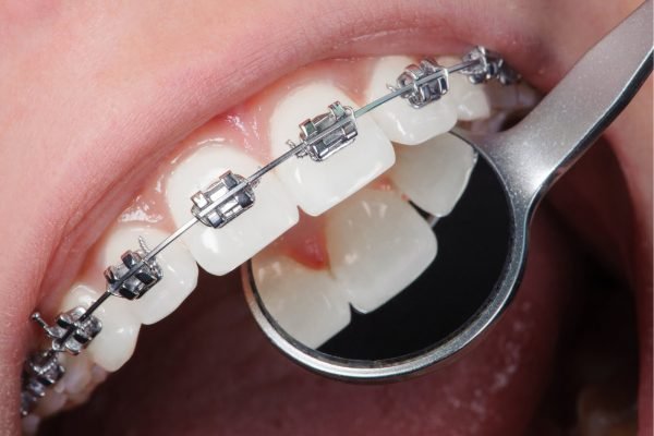 paitents with braces